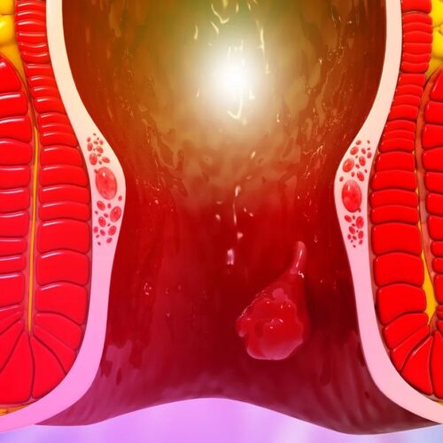 Anorectal Surgery – Haemorrhoids