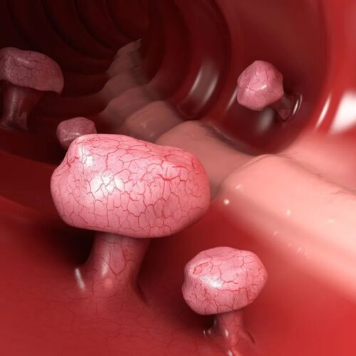 Colon Polyps / Tumours