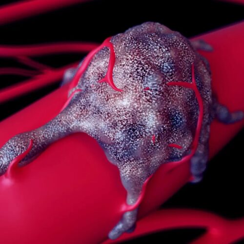 Rectal Polyps / Tumours