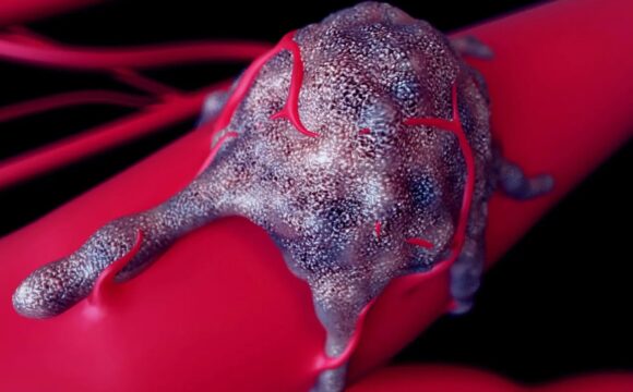 Rectal Polyps / Tumours