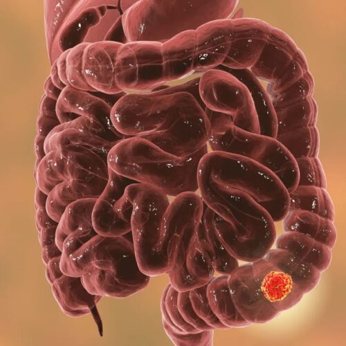 Anorectal Surgery – Rectal Prolapse