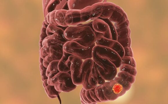 Anorectal Surgery – Rectal Prolapse